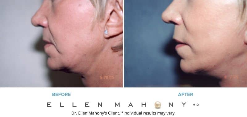 Before and After Image: Case #3238 - left-side