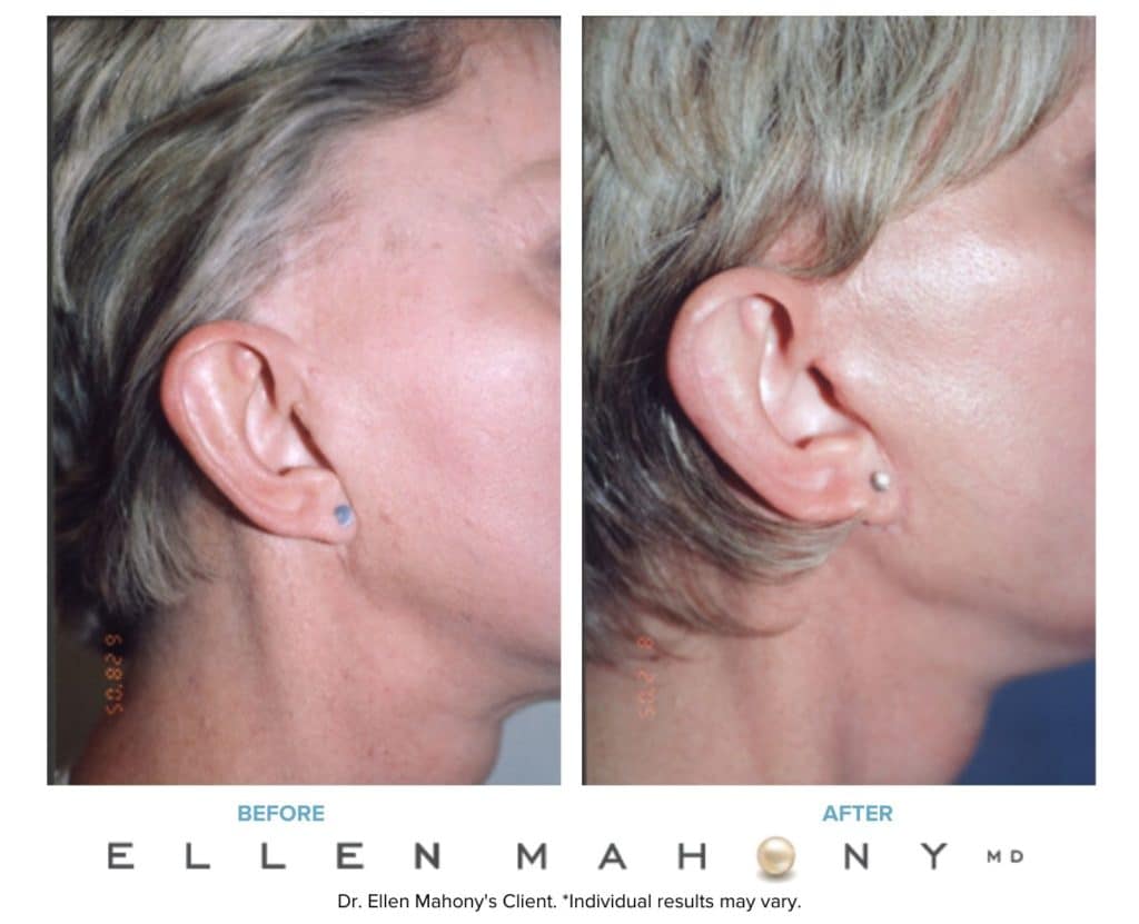 Before and After Image: Case #3238 - right-side