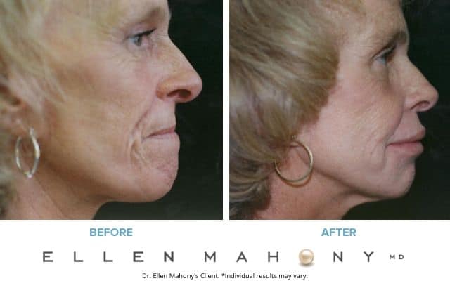 Before and After Image: Case #3360 - right-side