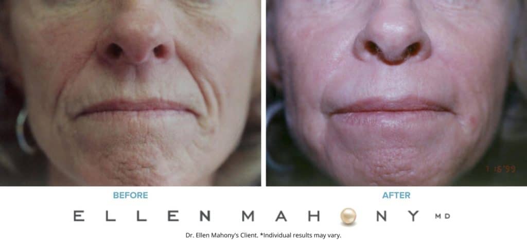 Before and After Image: Case #3360 - front