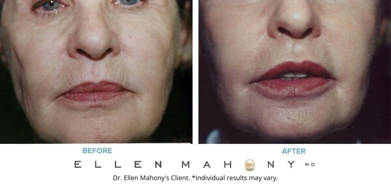 Before and After Image: Case #3390 - front