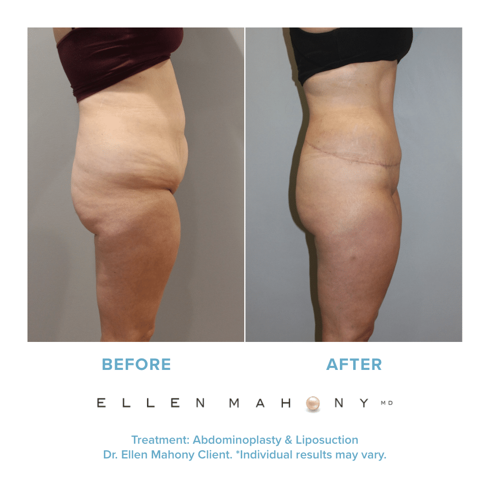 Before and After Image: Case #12217 - right-side