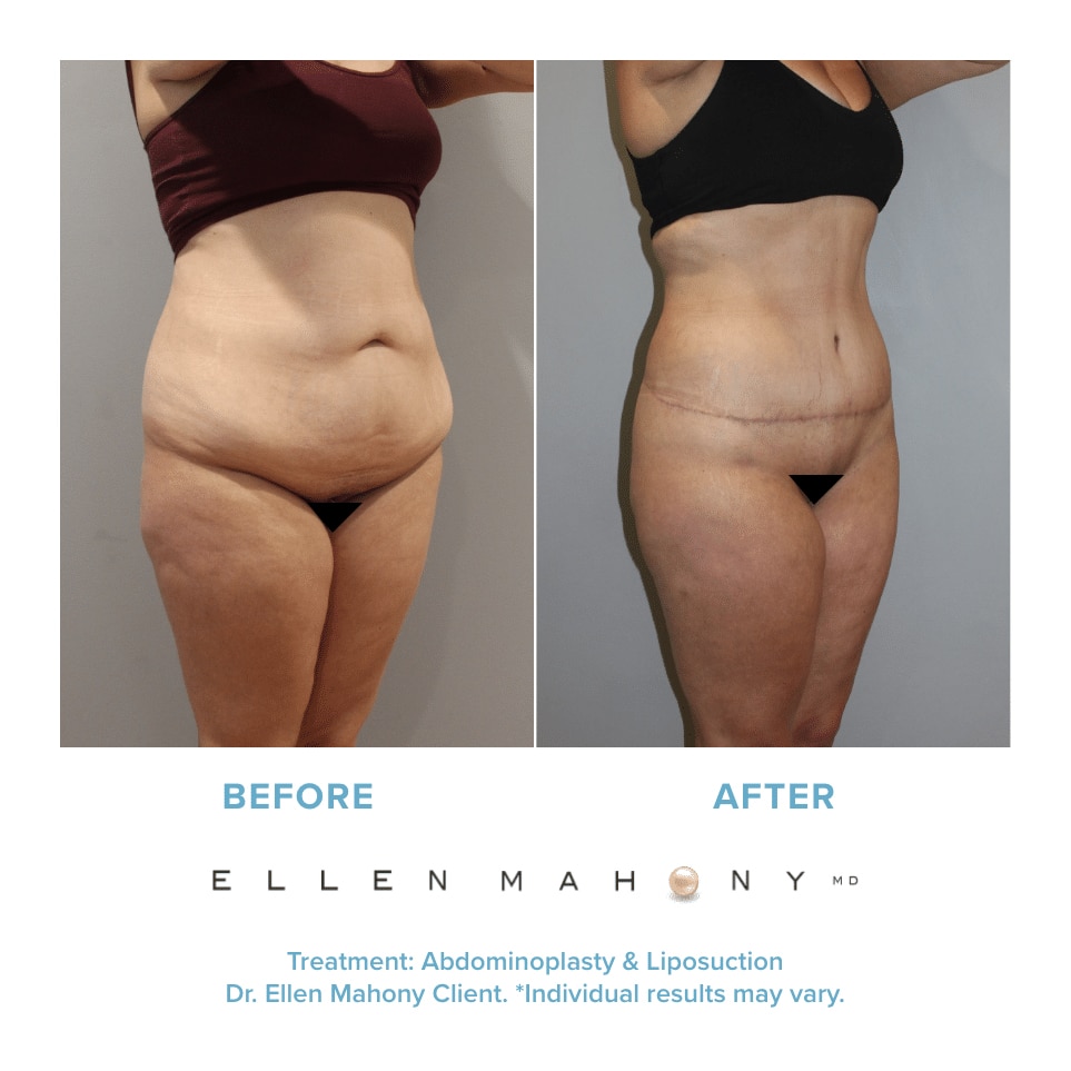 Before and After Image: Case #12217 - right-front-oblique