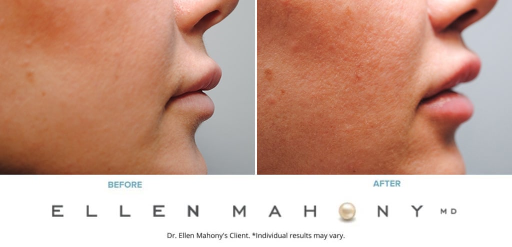 Before and After Image: Case #9508 - right-side