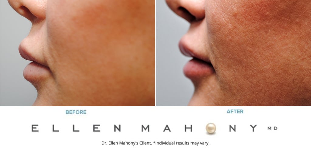Before and After Image: Case #9508 - left-side