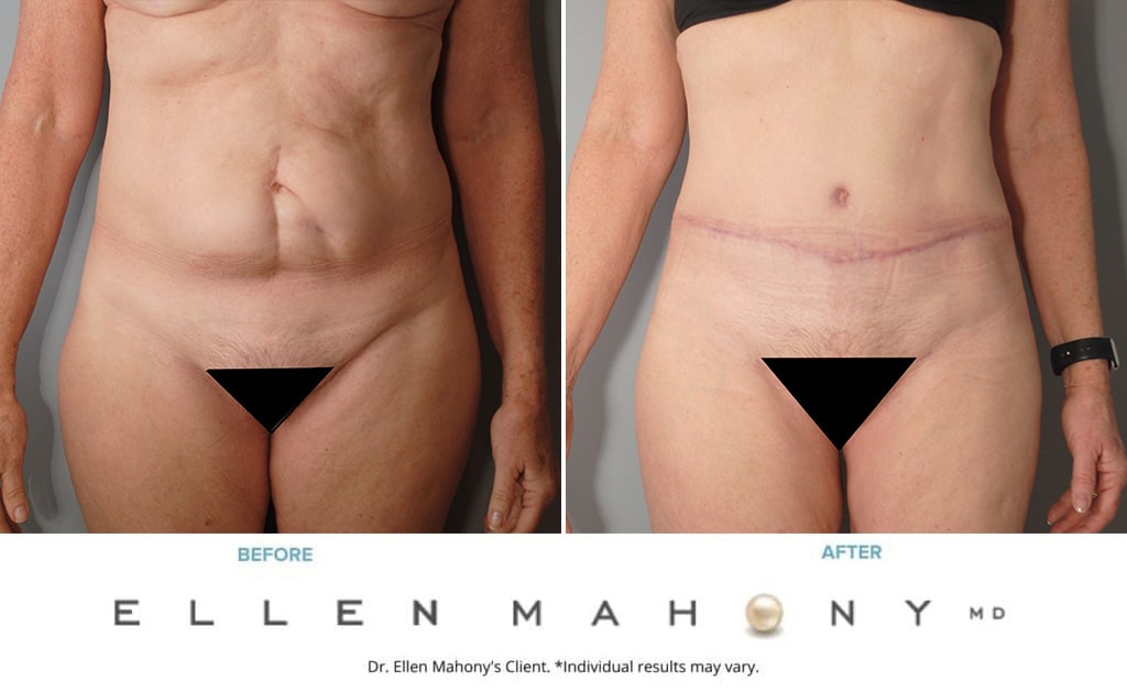 Before and After Image: Case #4017 - front