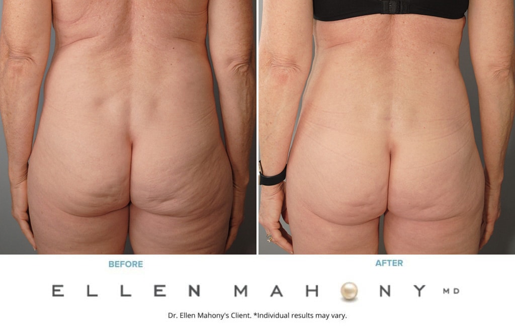 Before and After Image: Case #4017 - back