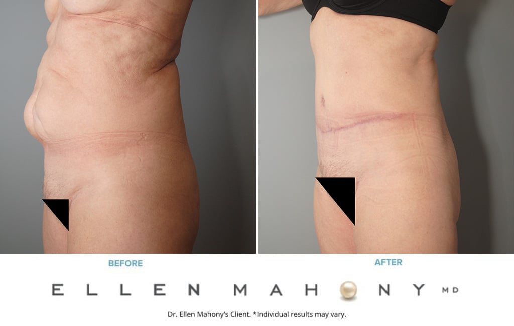 Before and After Image: Case #4017 - left-front-oblique