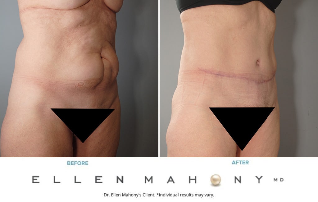 Before and After Image: Case #4017 - right-front-oblique