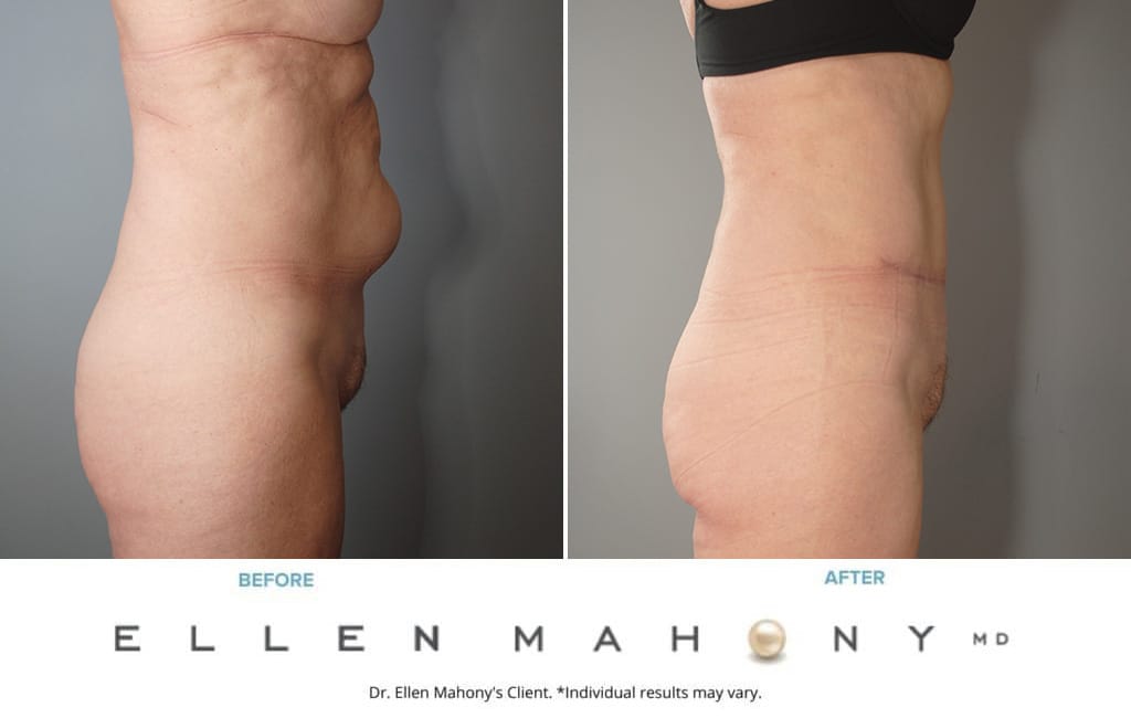 Before and After Image: Case #4017 - right-side