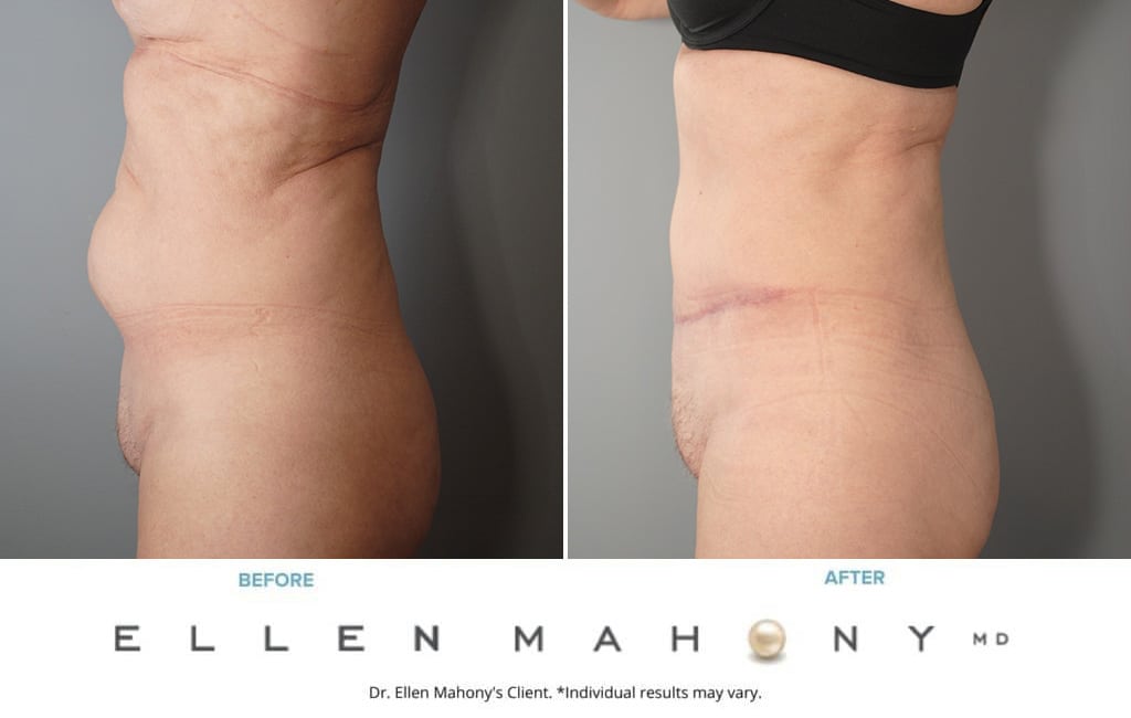 Before and After Image: Case #4017 - left-side