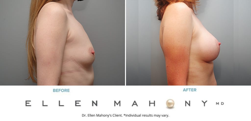 Before and After Image: Case #10067 - right-side