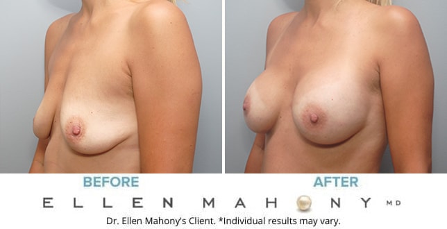 Before and After Image: Case #9700 - left-front-oblique