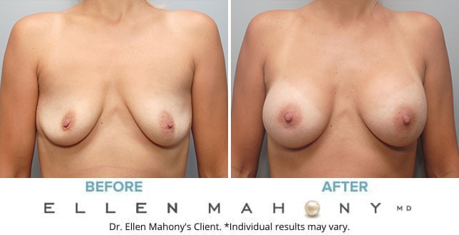 Before and After Image: Case #9700 - front