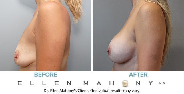 Before and After Image: Case #9700 - left-side