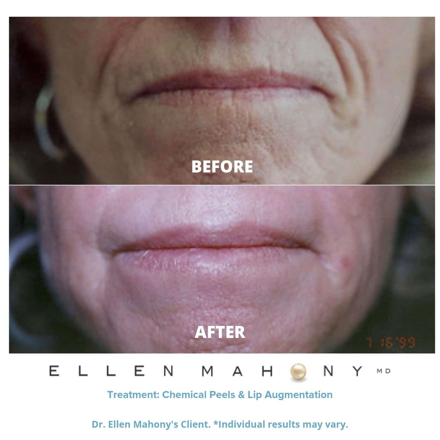 Before and After Image: Case #3360 - front