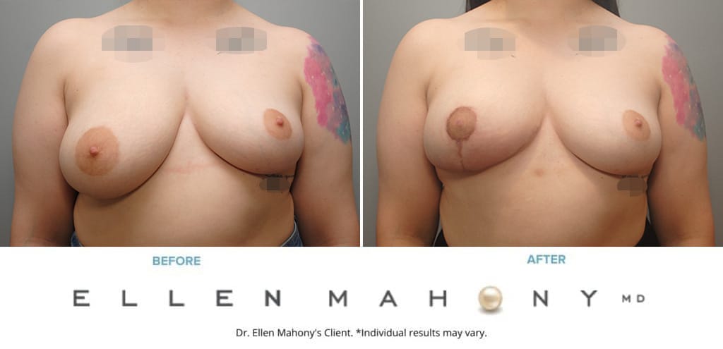 Before and After Image: Case #10033 - front