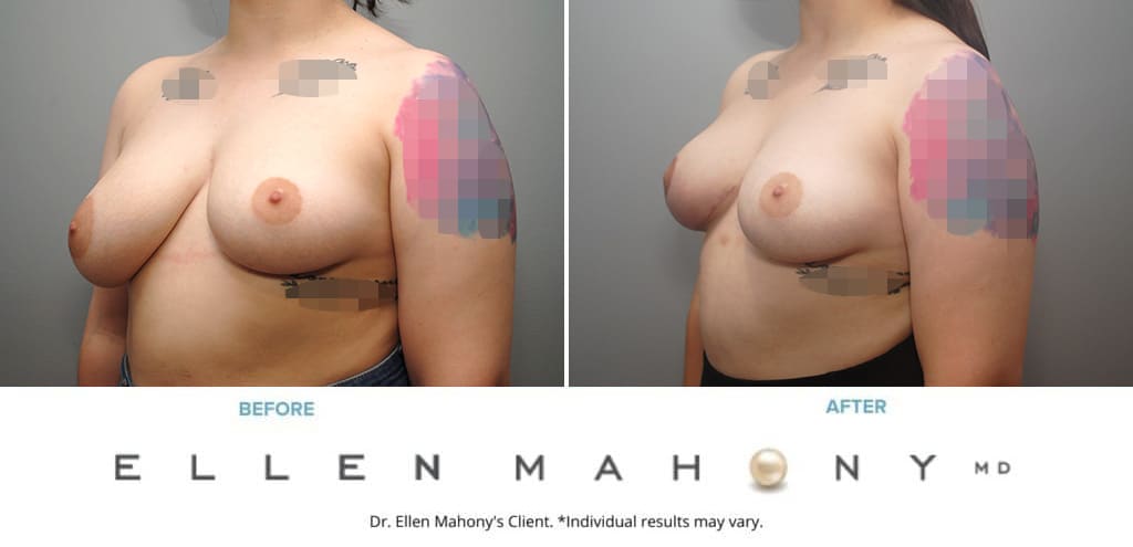 Before and After Image: Case #10033 - left-front-oblique