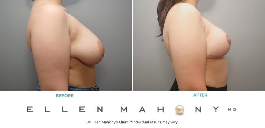 Before and After Image: Case #10033 - right-side