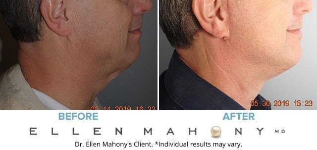 Before and After Image: Case #7949 - right-side