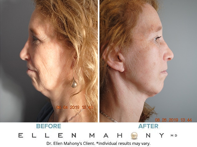 Before and After Image: Case #4963 - front