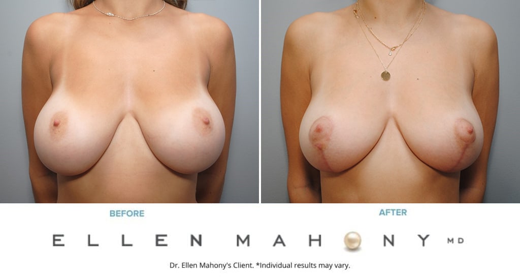 Before and After Image: Case #9067 - front