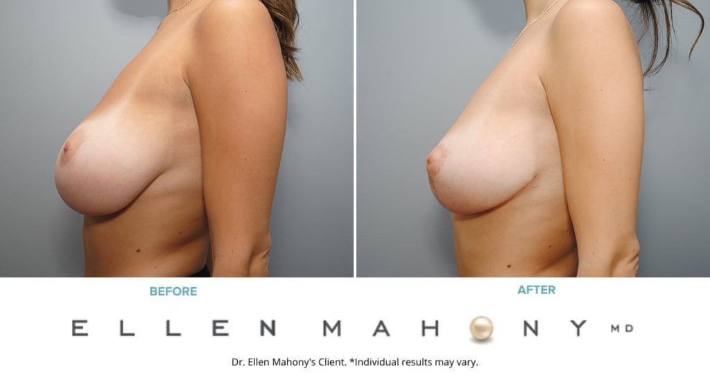 Before and After Image: Case #9067 - left-side