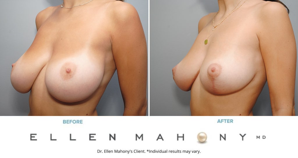 Before and After Image: Case #9067 - left-front-oblique