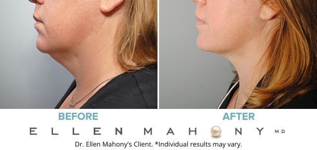 Before and After Image: Case #4837 - left-side