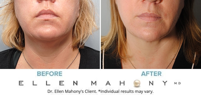 Before and After Image: Case #4837 - front