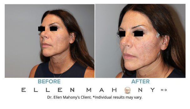 Before and After Image: Case #5294 - left-front-oblique