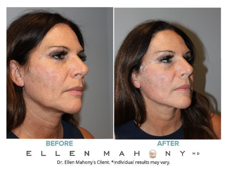 Before and After Image: Case #5294 - right-front-oblique