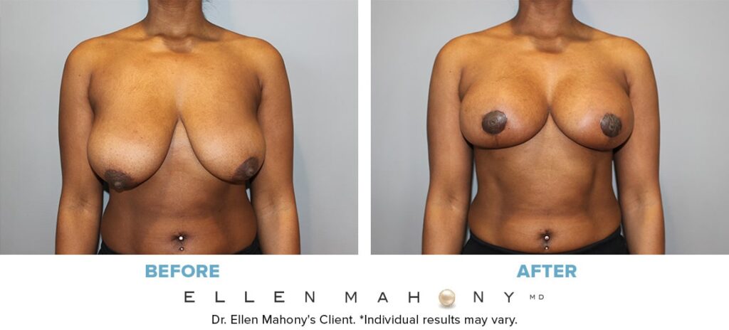 Before and After Image: Case #13331 - front