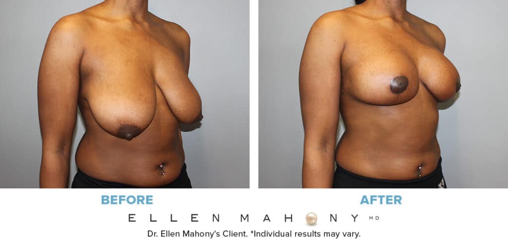 Before and After Image: Case #13331 - right-front-oblique