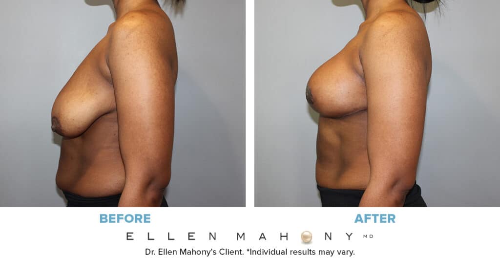 Before and After Image: Case #13331 - left-side