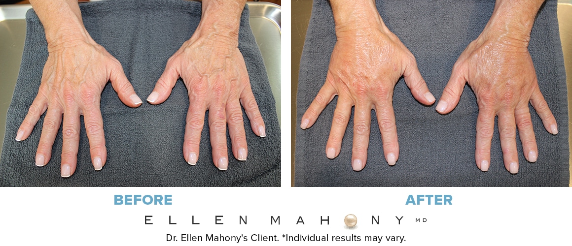 Before and After Image: Case #10012 - front
