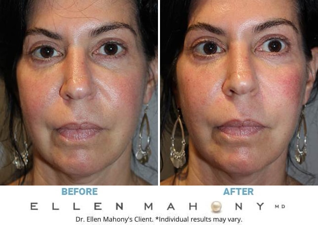 Before and After Image: Case #11454 - front
