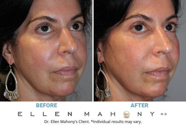 Before and After Image: Case #11454 - right-front-oblique