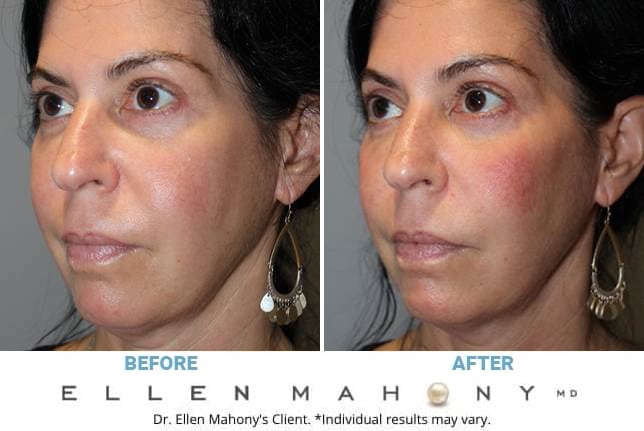 Before and After Image: Case #11454 - left-front-oblique