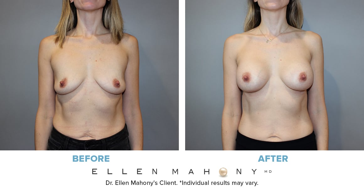 Before and After Image: Case #13048 - front