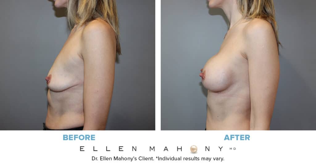 Before and After Image: Case #13048 - left-side