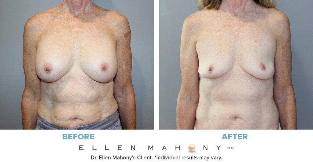 Before and After Image: Case #4020 - front