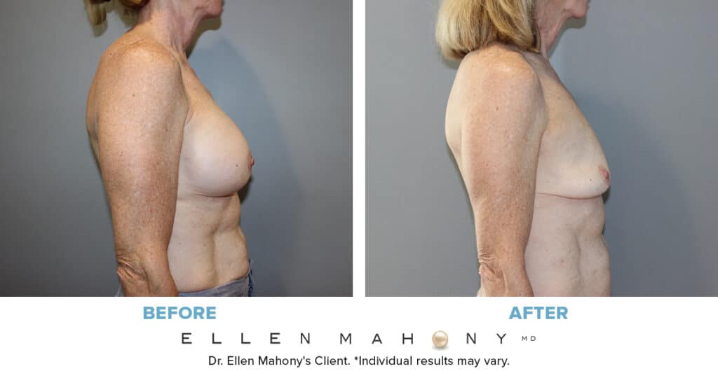 Before and After Image: Case #4020 - right-side