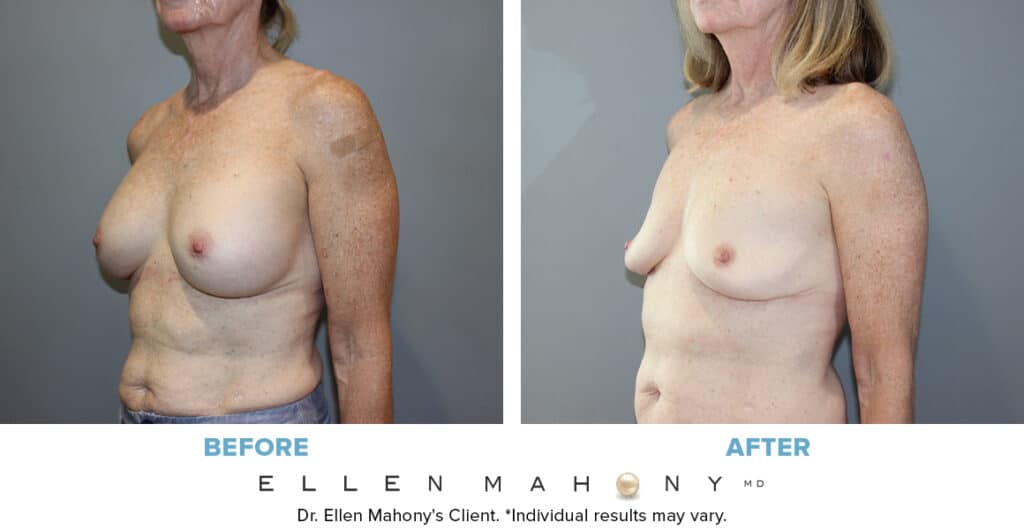 Before and After Image: Case #4020 - left-front-oblique