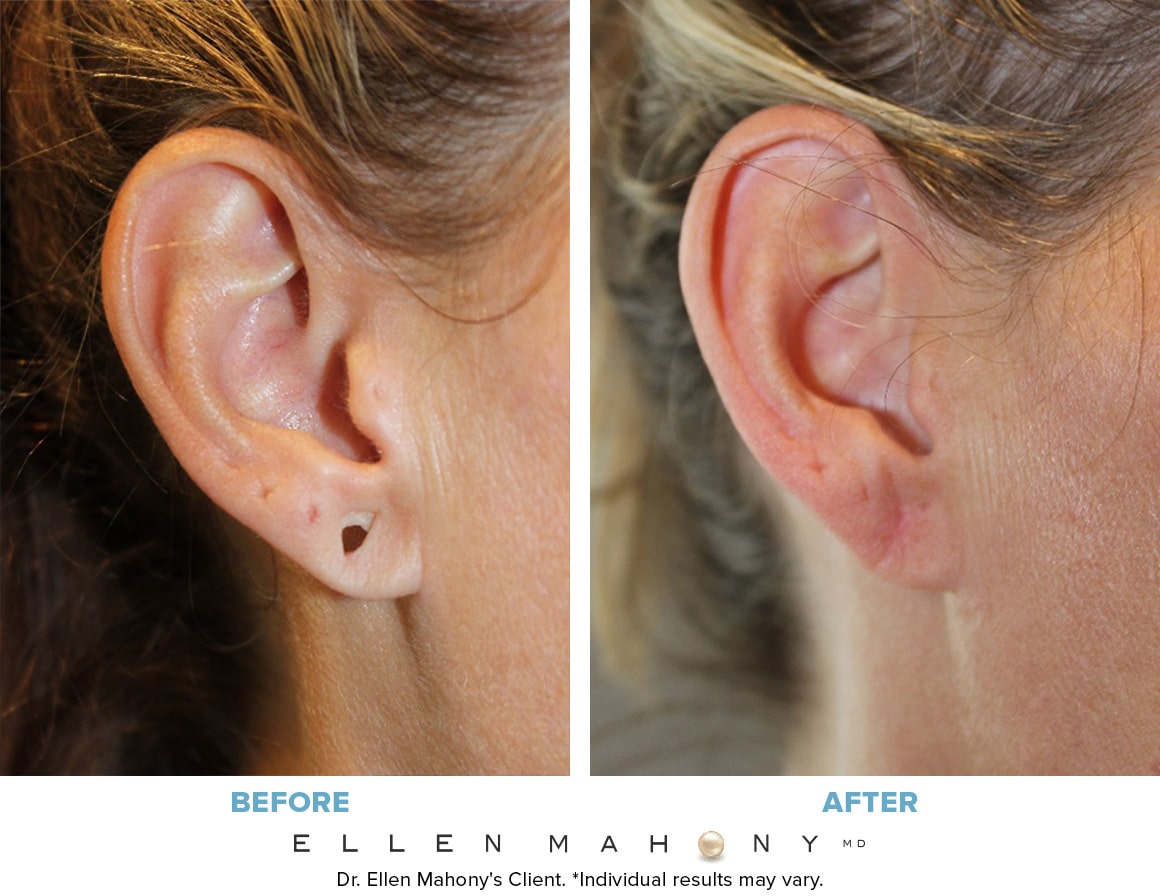 Before and After Image: Case #6191 - right-side