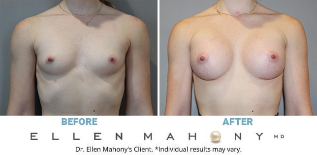 Before and After Image: Case #12423 - front