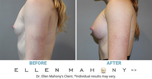 Before and After Image: Case #12423 - left-side