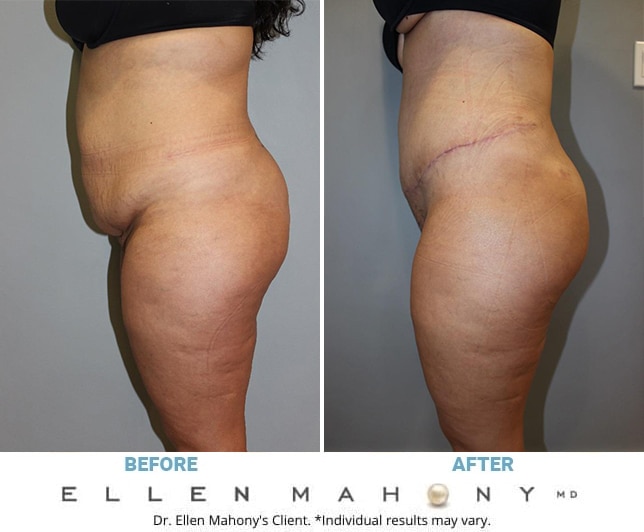 Before and After Image: Case #12591 - left-side