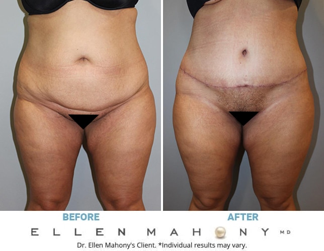 Before and After Image: Case #12591 - front