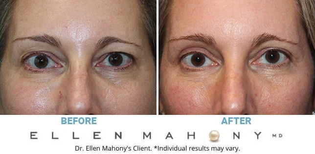 Before and After Image: Case #12814 - front